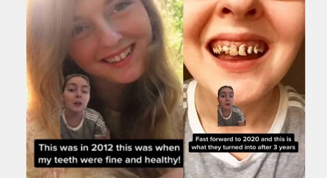 10 yıldır aşırı soda tüketen genç kızın dişleri döküldü