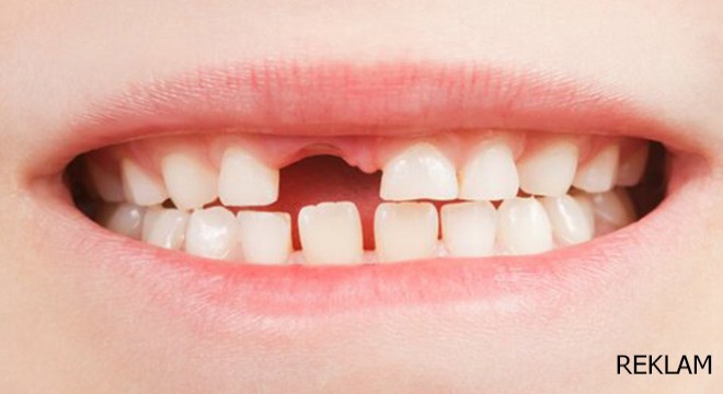 Diş Eksikliği Tedavisi Nedir?