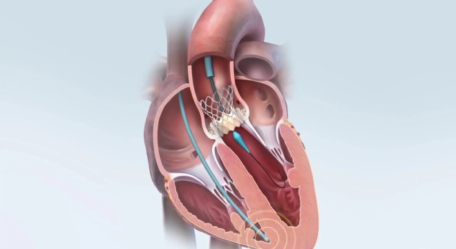 Kalp Sağlığınız İçin Minimal İnvaziv Bir Çözüm