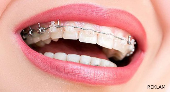 Ortodontik Tedavi Süreçleri Hakkında Bilinmesi Gerekenler