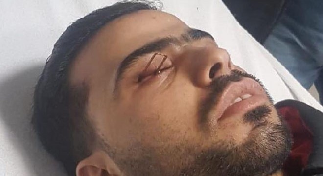Suriyeli işçinin gözüne zımba çivisi saplandı