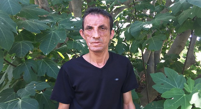 'Önce yüzüm şimdi de anılarım yandı'