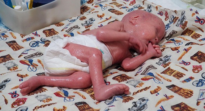 'Yılan bebek' Gökdeniz 1 yaşında