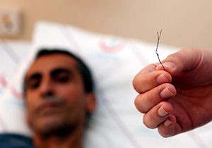Bağırsağından 10 santimlik tel çıktı