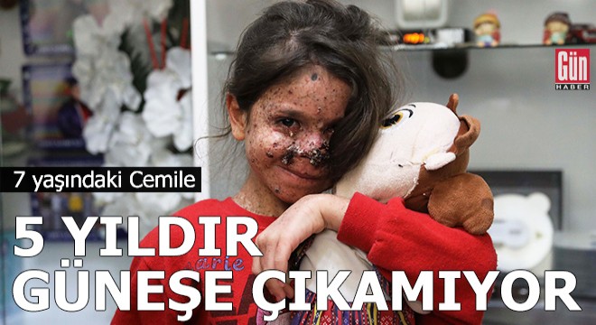 7 yaşındaki Cemile, 5 yıldır güneşe çıkamıyor