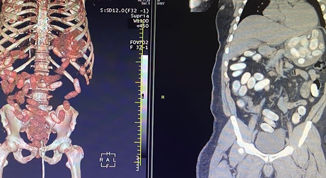 7 yolcunun midesinden 11 kilo kokain çıktı