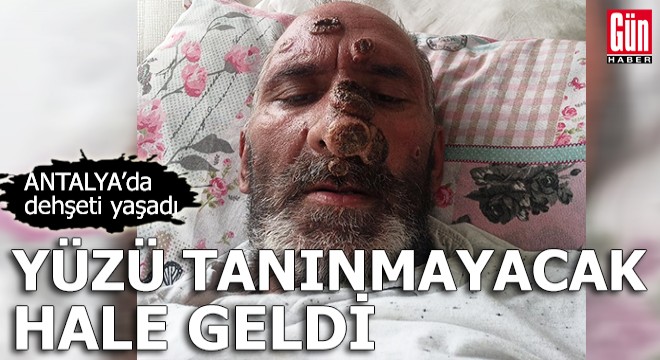 Antalya'da dehşeti yaşadı! Yüzü tanınmayacka hale geldi