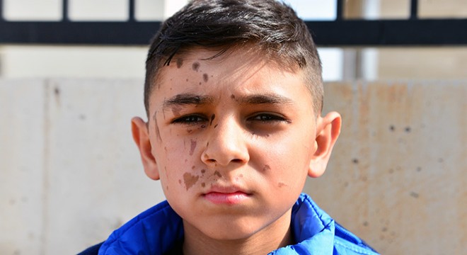 Arkadaşının döktüğü temizlik malzemesi Yiğit Ali'nin yüzünü yaktı