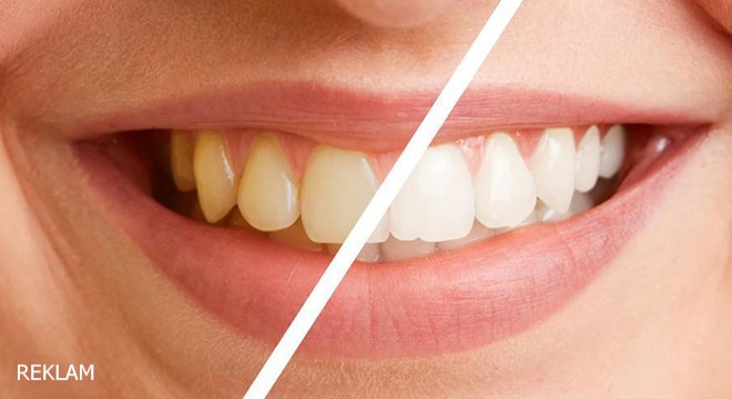 Bleaching İşlemi Nedir?