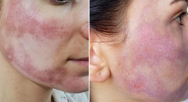 Cansu'nun yüzünü yakan güzellik merkezi sorumlularına ceza