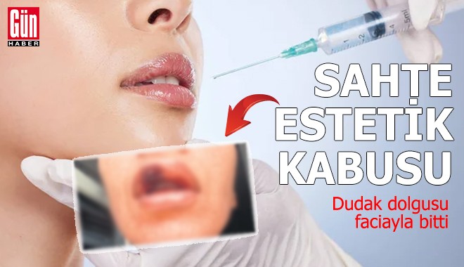 Dudak dolgusu faciayla bitti