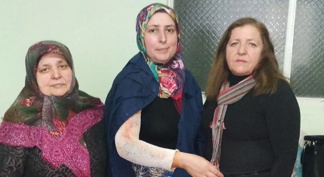 Eşi tarafından kolu yakılan kadına destek