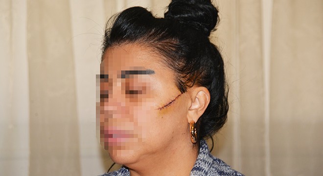 Eski sevgilisi, bu kez de yüzünü usturayla kesti