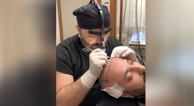 Este Surgery SDHI Hair Transplant