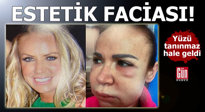 Estetik faciası! Yüzü tanınmaz hale geldi
