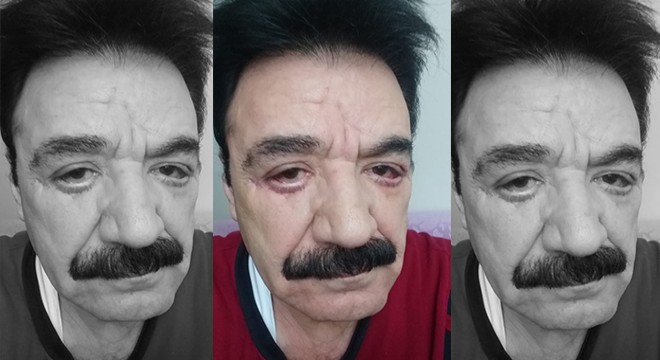 Göz doktoruna "Hatalı estetik" iddiası