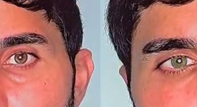 Göz rengini kalıcı olarak değiştirmek mümkün