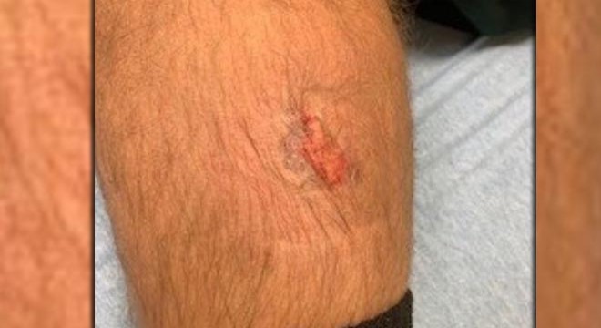 Gözaltı sırasında polisin bacağını ısırdı