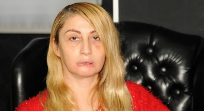 Güzellik uğruna kaybettiği alt dudağı eskisi gibi olmayacak
