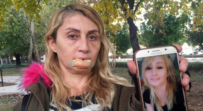 Güzellik uğruna kaybettiği dudağına yeniden kavuşacak