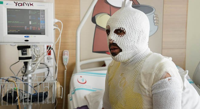 Haşlanmış olarak hastaneye geldi, 'Beni yaktılar' dedi