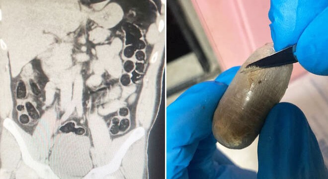 İranlı yolcunun midesinden 714 gram eroin çıktı