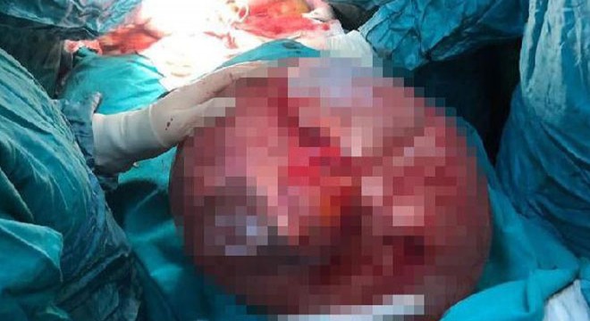 Karın ağrısıyla gitti, karnından 13 kiloluk kitle çıkarıldı
