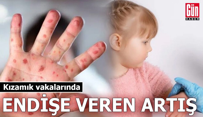 Kızamık vakalarında endişe veren artış