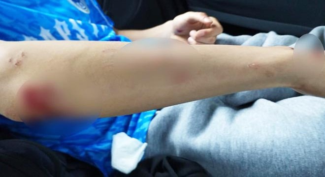 Köpeklerin saldırdığı lise öğrencisi yaralandı