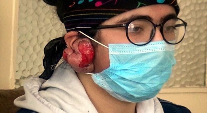 Kulaklarında keloid oluşan Yağmur, tedavi olamazsa duyamayacak