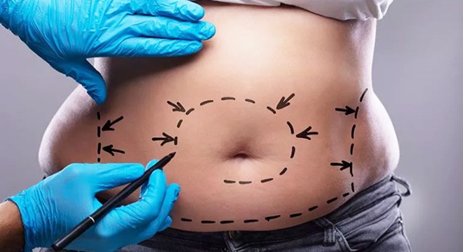 Liposuction Nedir? Yöntemleri Nelerdir?