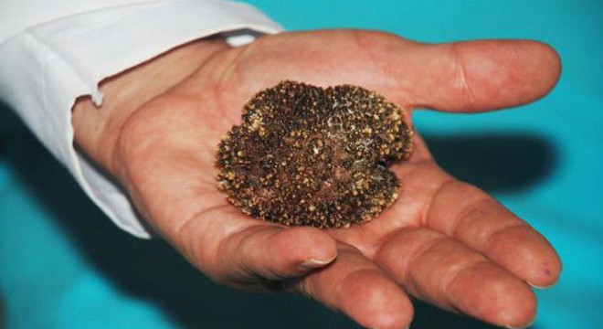 Mesanesinde 220 gramlık tek parça taş çıktı