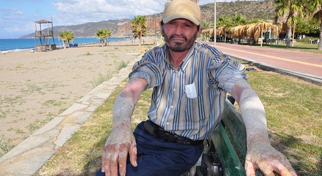 Sedef hastası Mustafa, iyileşip evlenmek istiyor