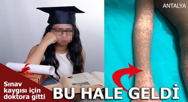 Sınav kaygısı için verilen ilacı kullanan genç kız,derisinin yüzde 40'ını kaybetti