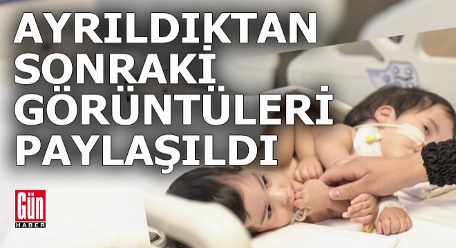 Siyam ikizleri iyileşti taburcu oluyor