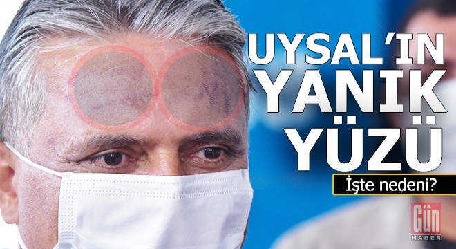 Ümit Uysal'ın yüzü neden yanmış?..