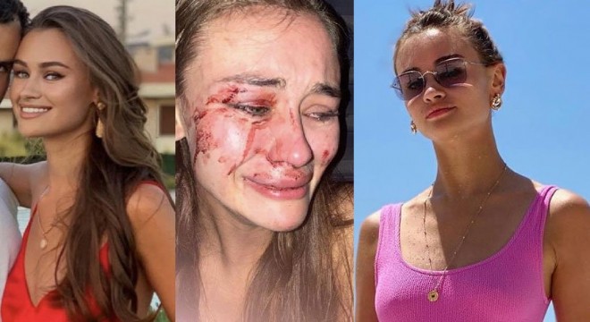 Ünlü modeli güvenlikçiler bu hale getirdi