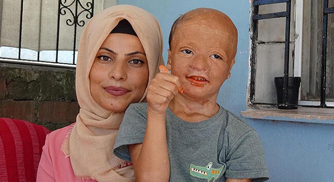 Yangında yaralanan 9 yaşındaki Halil, doku nakli için bekliyor