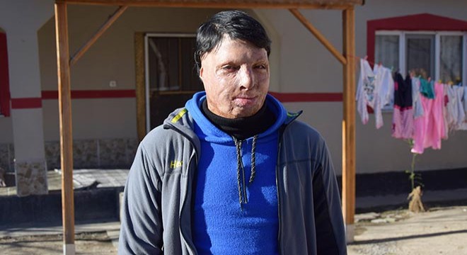 Yanık izleri nedeniyle evden çıkamayan Miraç, tedavi olmak istiyor