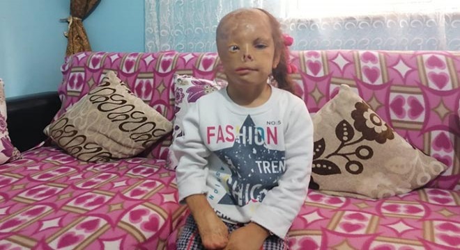 Yüzü yanan Dilara için Sağlık Bakanlığı devreye girdi