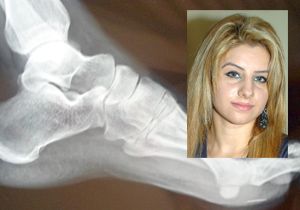 Yuttuğu iğne ayak başparmağından çıktı