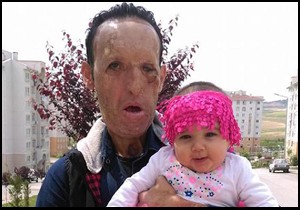 Yüz nakilli Sert, kızıyla fotoğrafını paylaştı