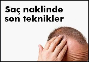 Saç naklinde son teknikler