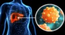 300 milyondan fazla kişi enfekte: Viral hepatitlere dikkat