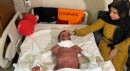 Antalya'da vücudu yanan Mustafa, deri nakliyle hayata tutundu