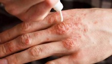 Ciltte kaşıntı ve kızarıklığa dikkat