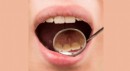 Diş taşı nedir, nasıl oluşur?