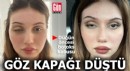 Düğün öncesi botoks kabusu: Göz kapağı düştü