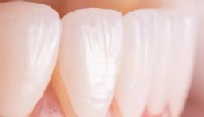 Emax Diş Kaplama Nedir?