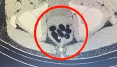 Midesinden yarım kilo metamfetamin çıktı